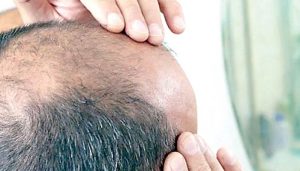 صرف تین ہفتوں میں نئے بال ، سائنسدانوں نے گنج پن کا علاج دریافت کر لیا